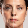 2-O-que-e-e-como-ficar-o-rosto-apos-aplicacao-de-skinbooster-1024x536
